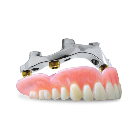 Implant Bar Overdenture